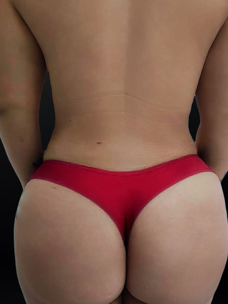 Brazilian Butt Lift, after