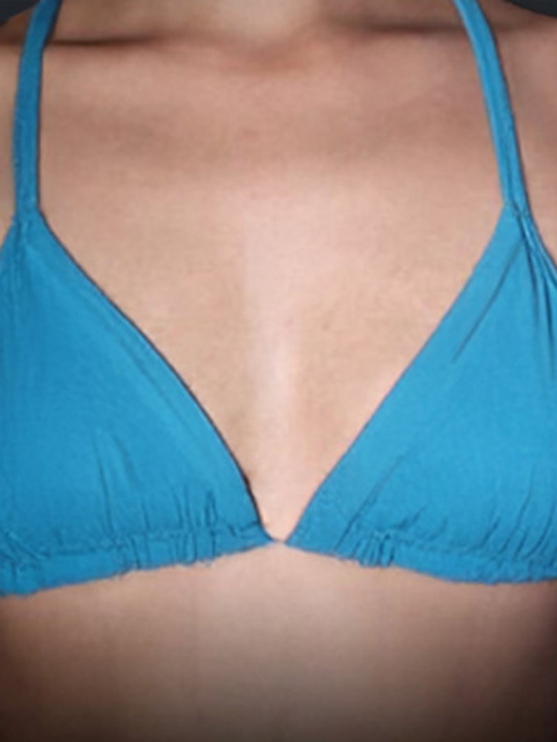 Breast Augmentation, before
