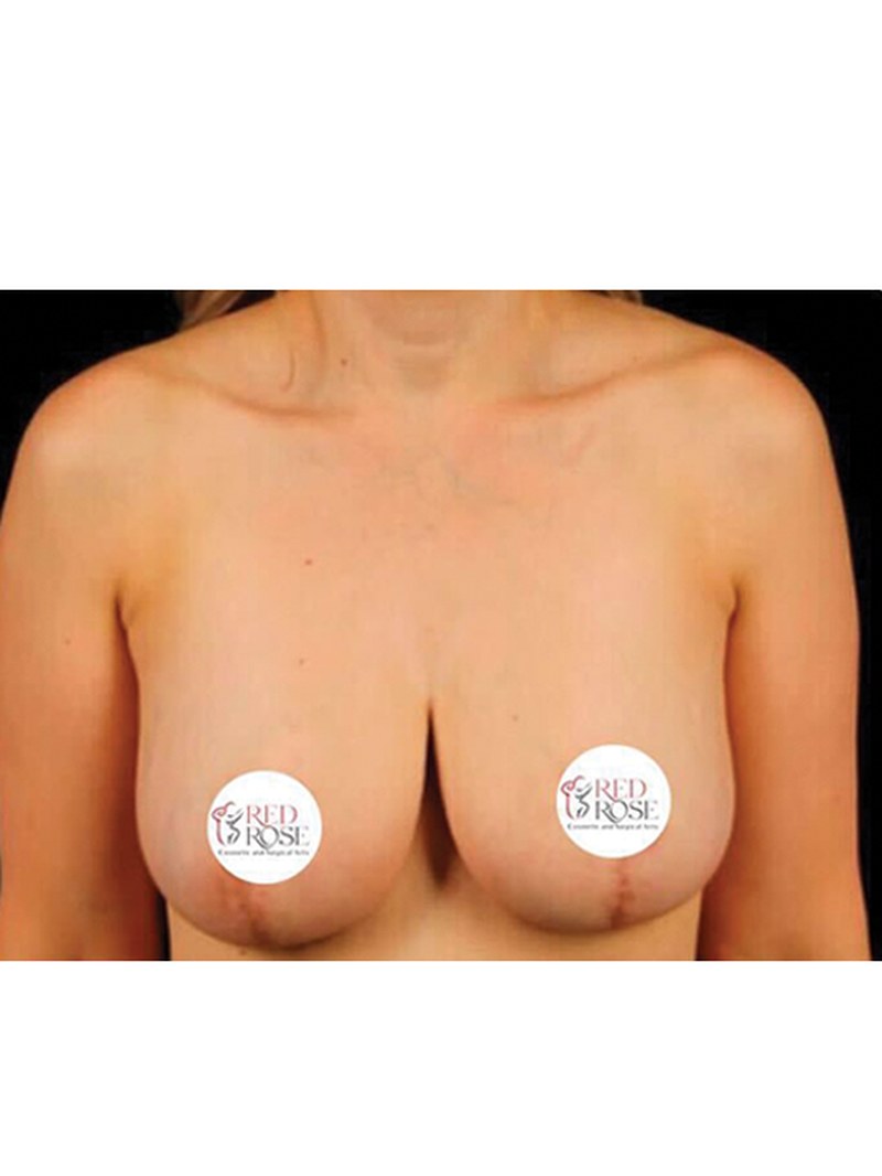 Breast Lift, after