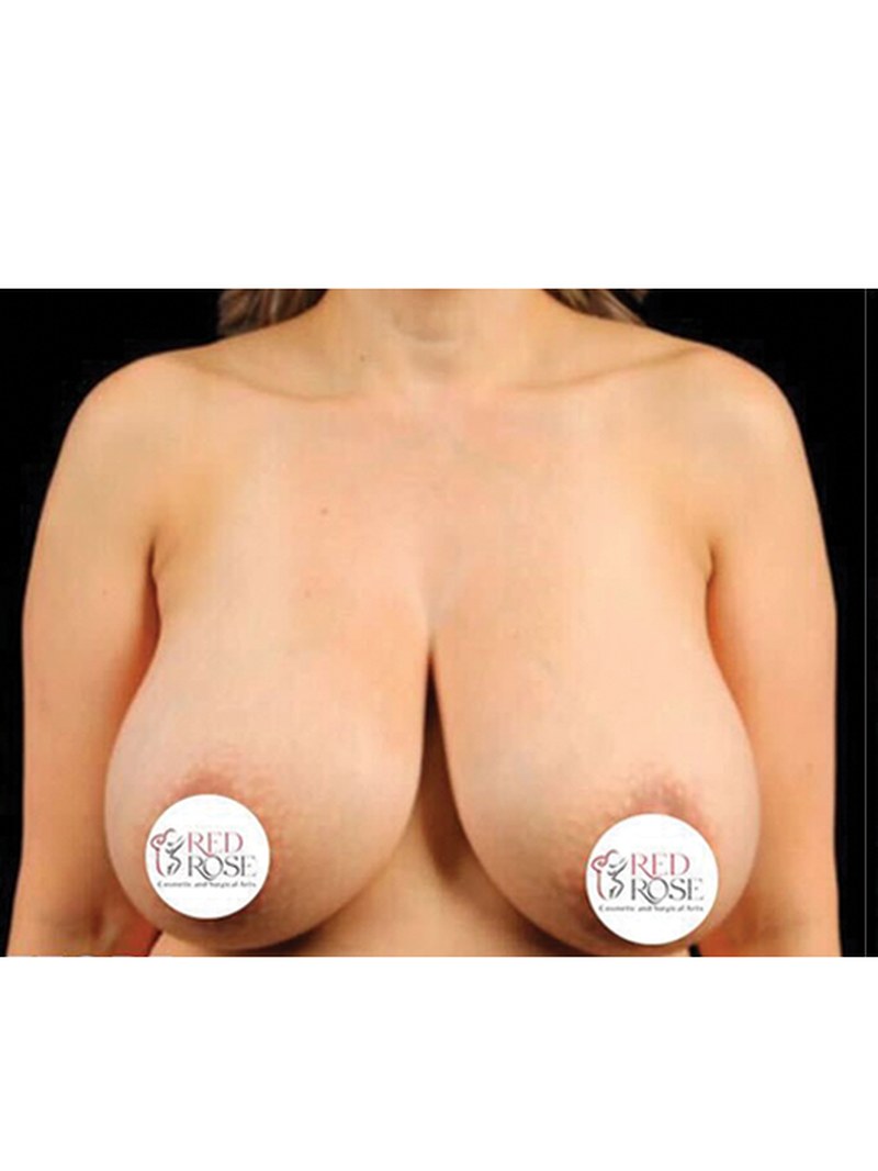 Breast Lift, before