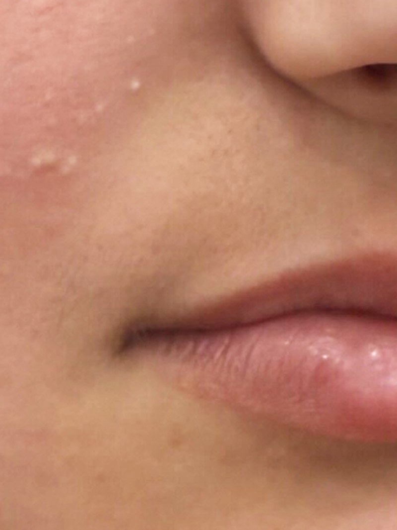 Facelift, before