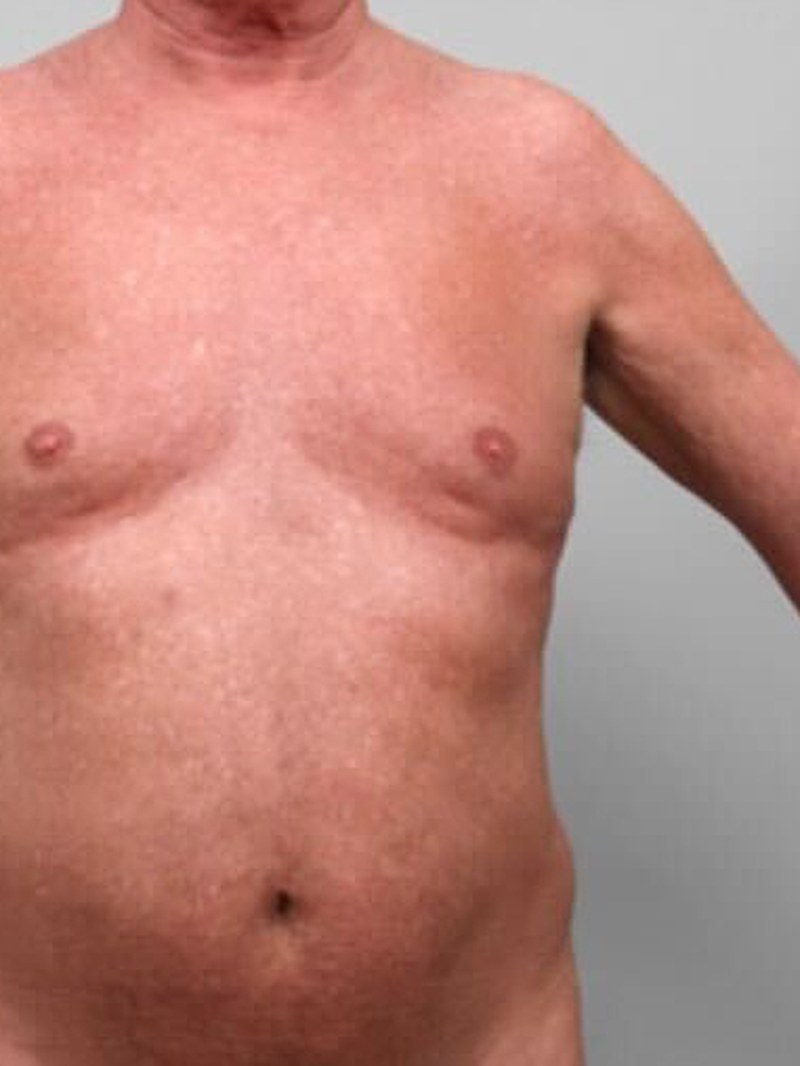 Lipo 360, before