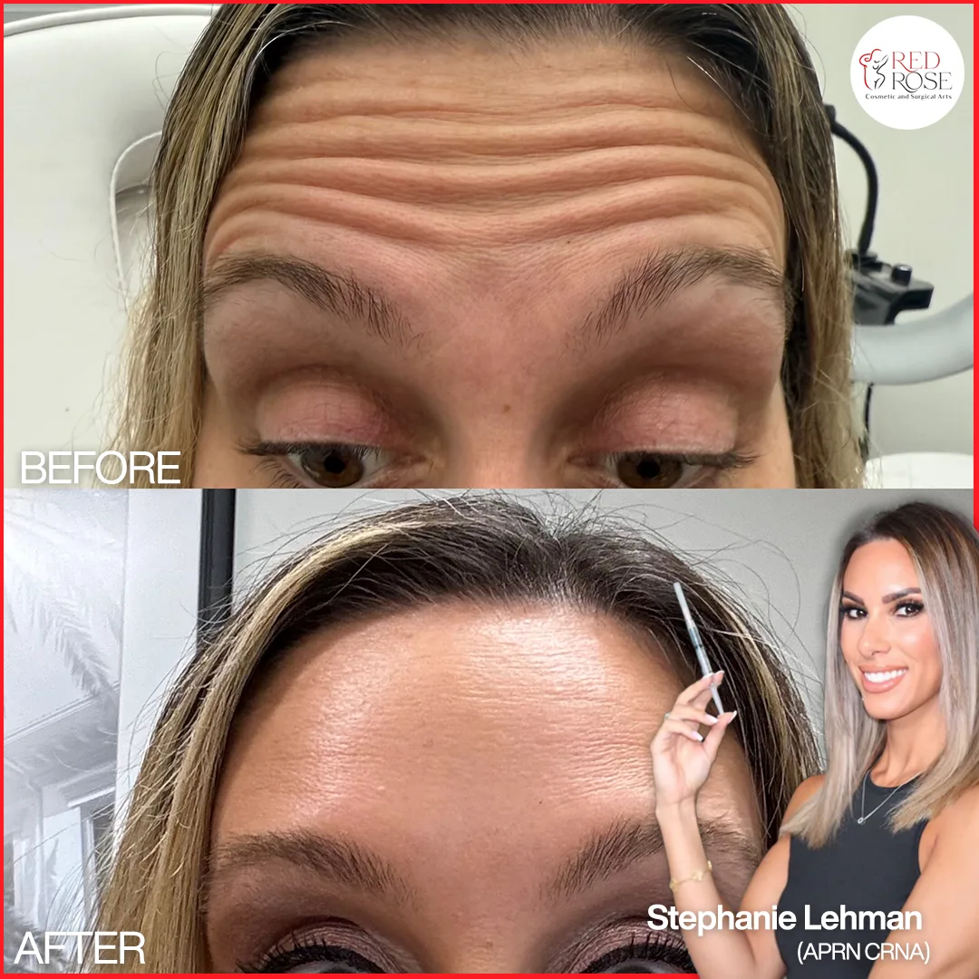 Before and after injectables and filler at Red Rose Surgical
