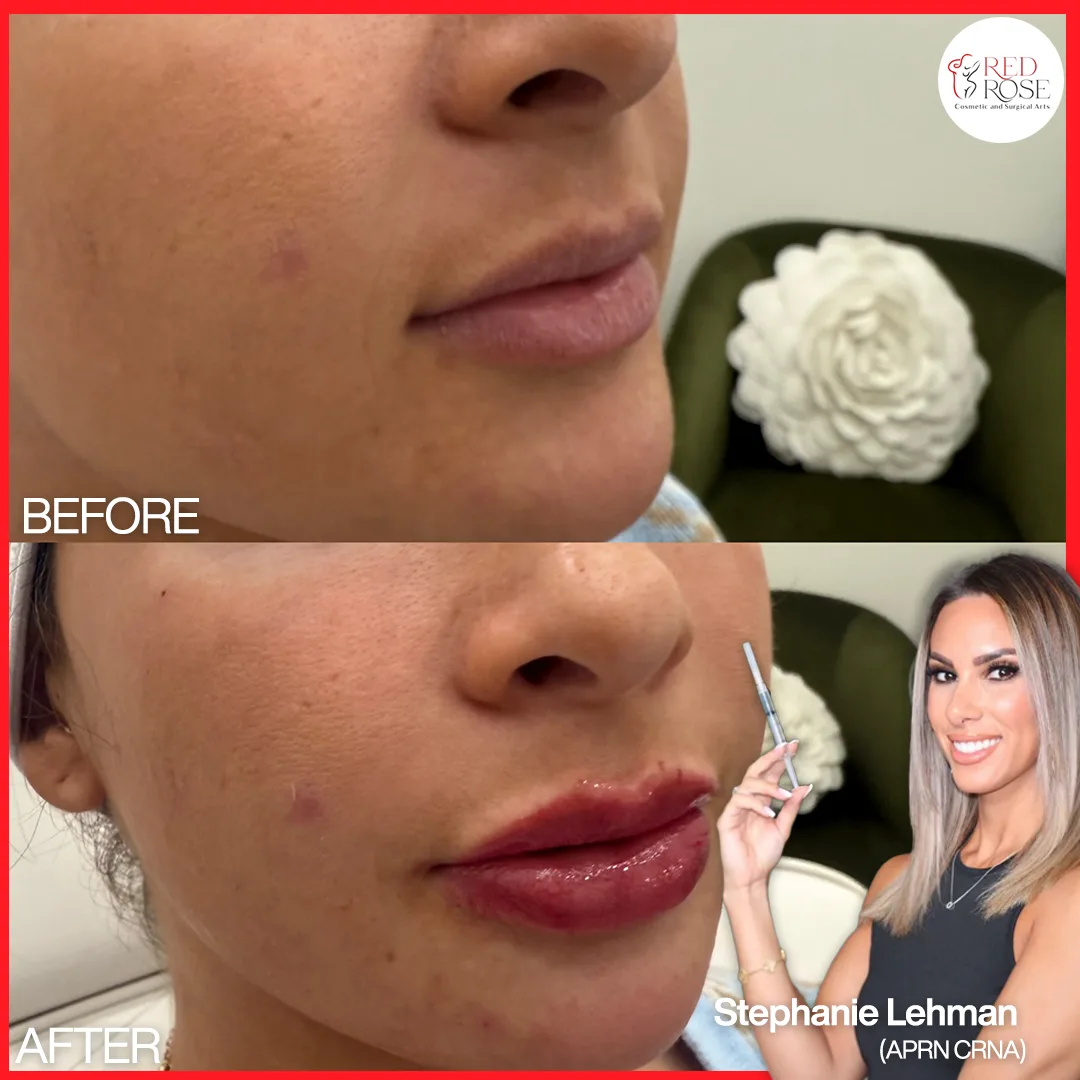 Before and after injectables and filler at Red Rose Surgical