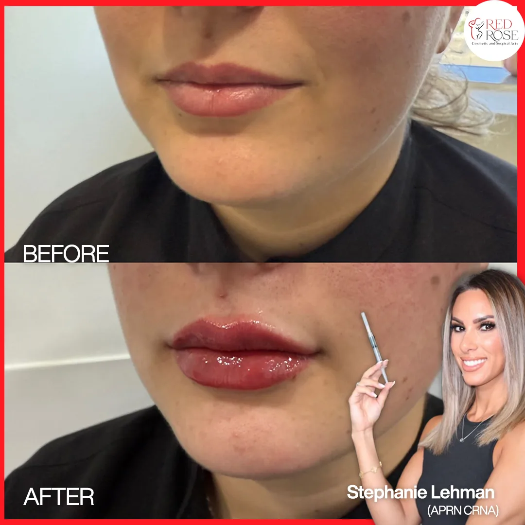 Before and after injectables and filler at Red Rose Surgical