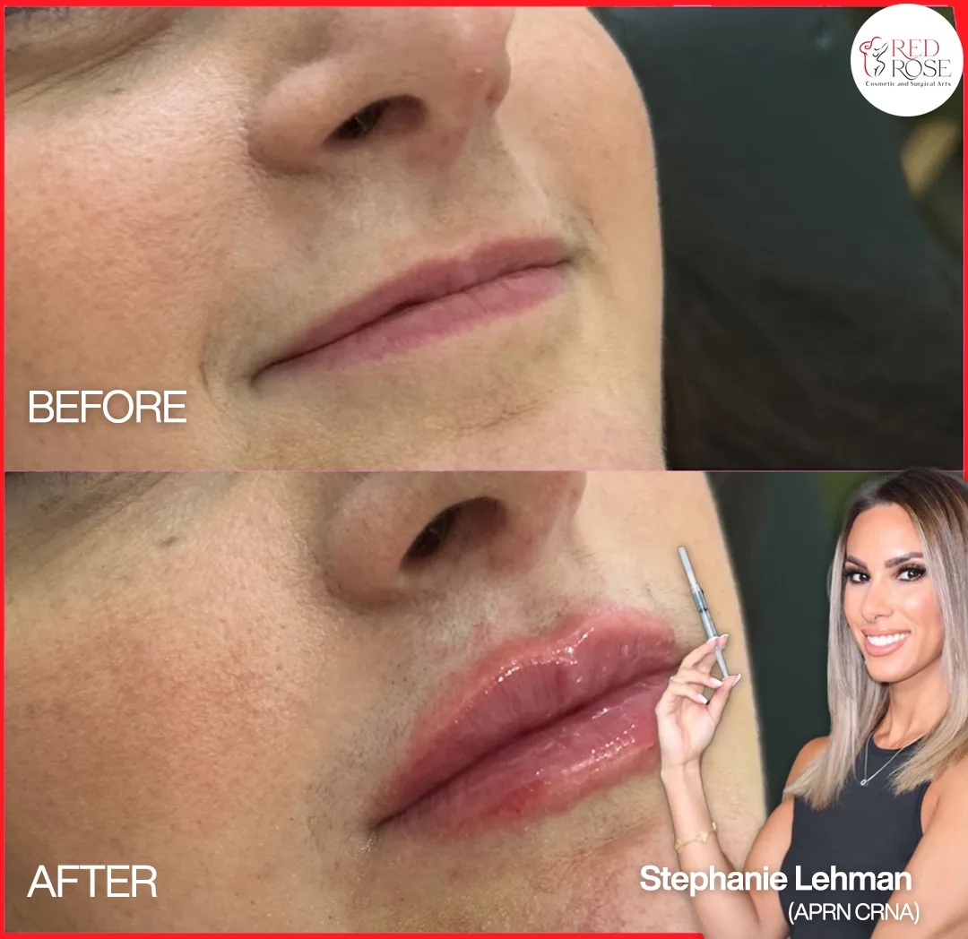 Injectables before and after at Red Rose Surgical