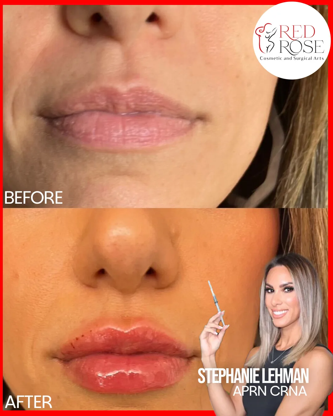 Before and after Facelift at Red Rose Surgical