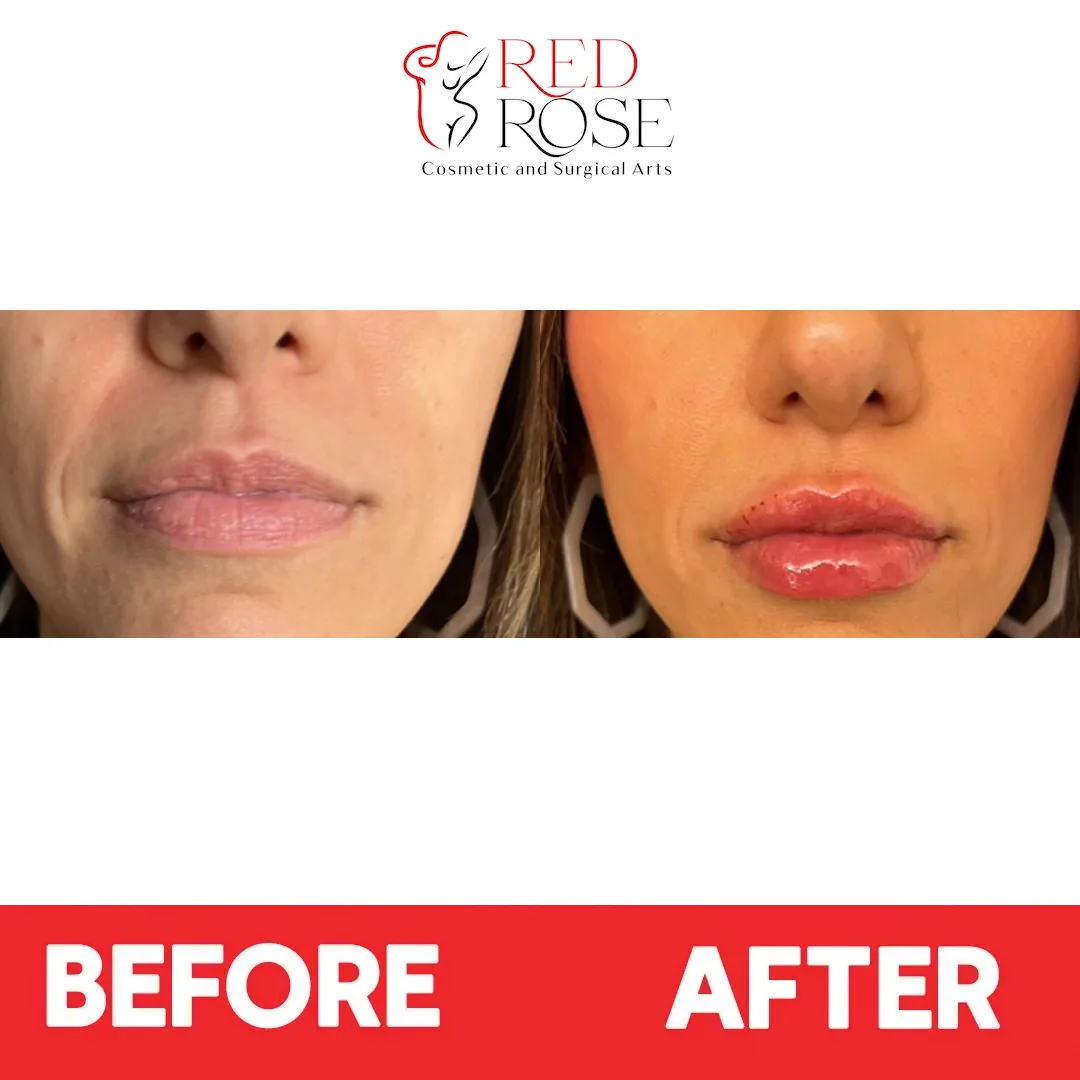 Face Lift before and after at Red Rose Surgical