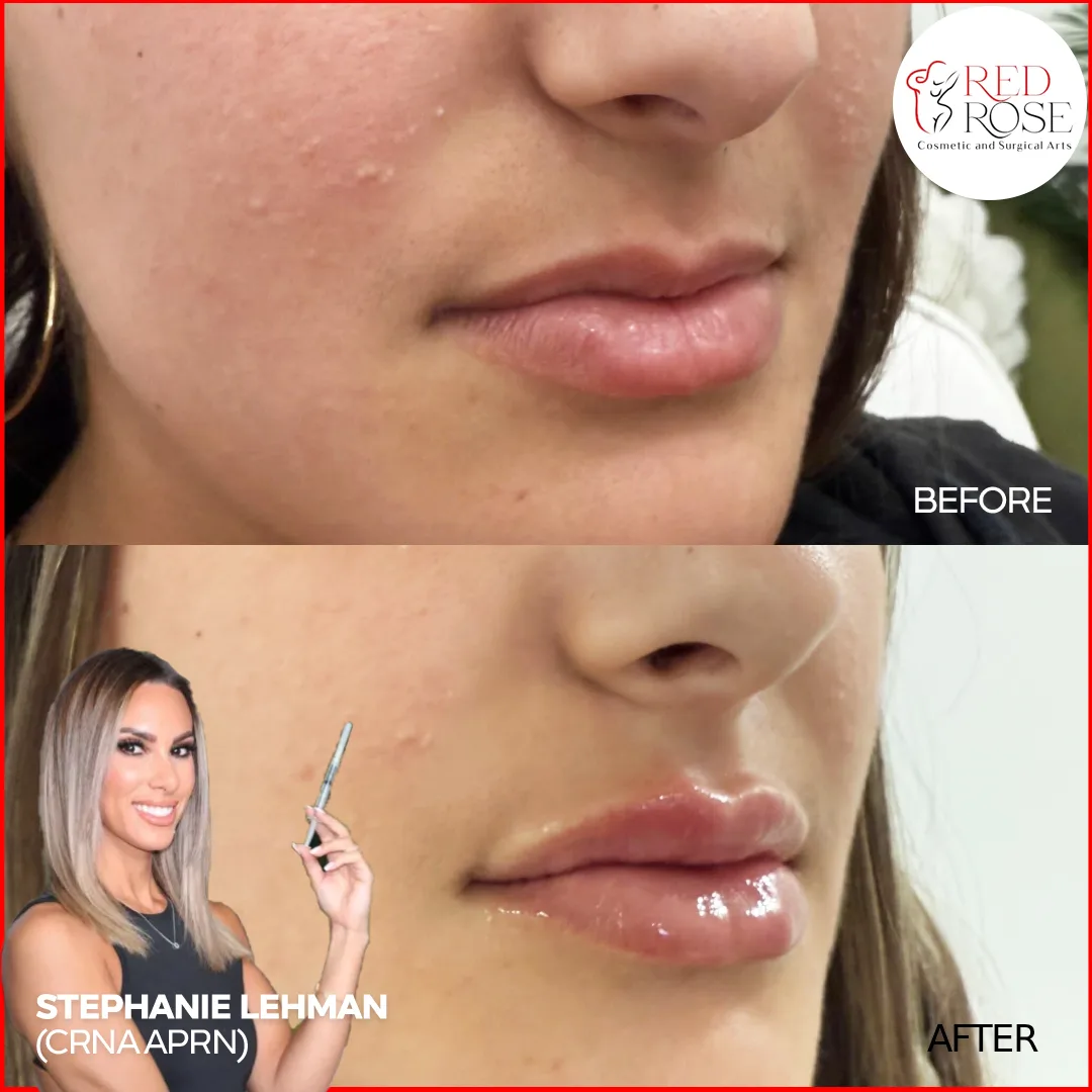 Before and after Facelift at Red Rose Surgical