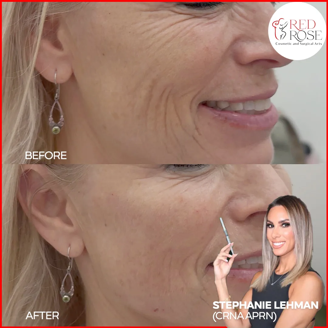 Before and after Facelift at Red Rose Surgical