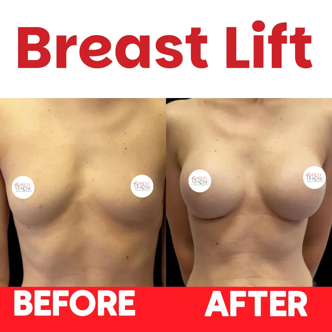 Before and after Breast Lift at Red Rose Surgical