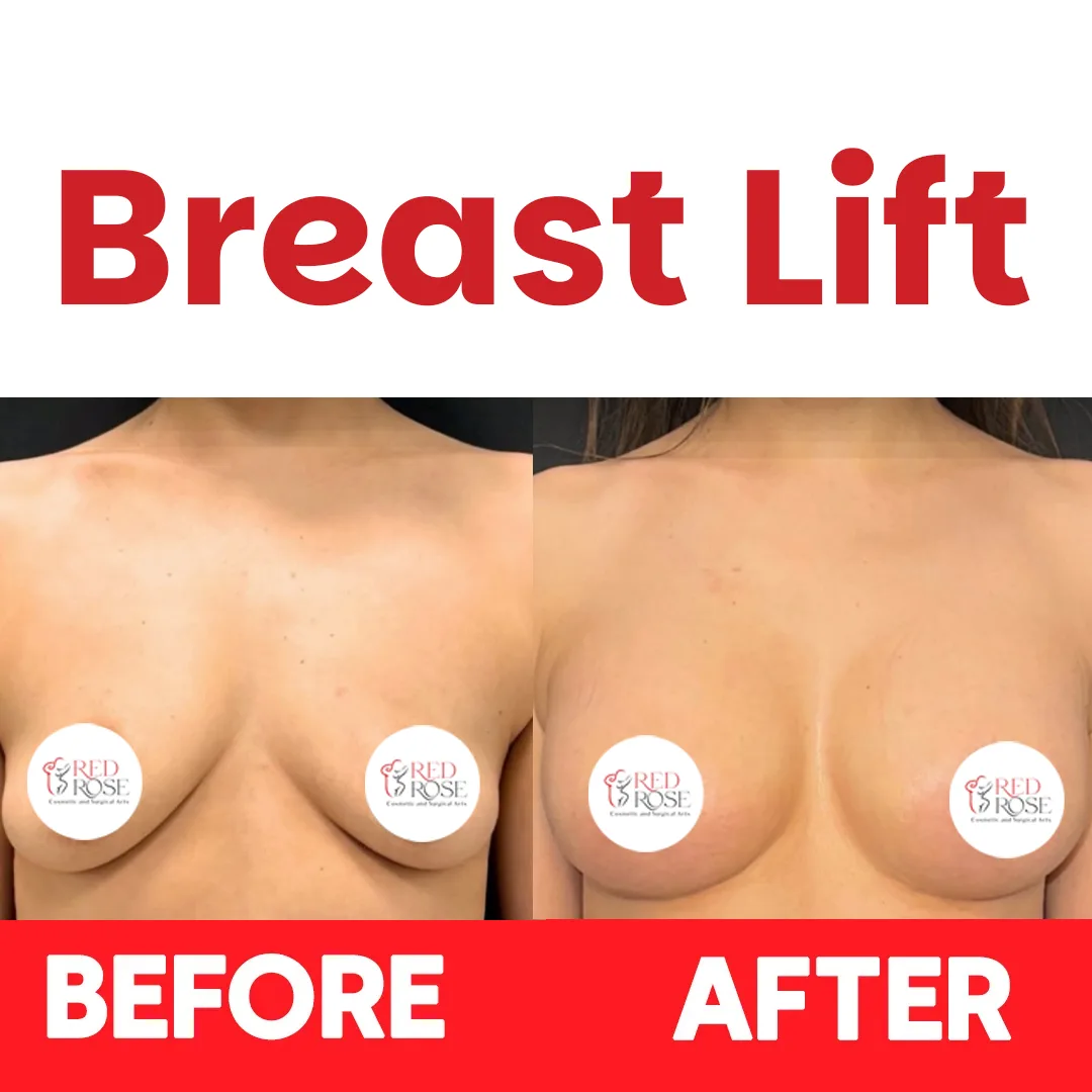Breast Lift before and after at Red Rose Surgical