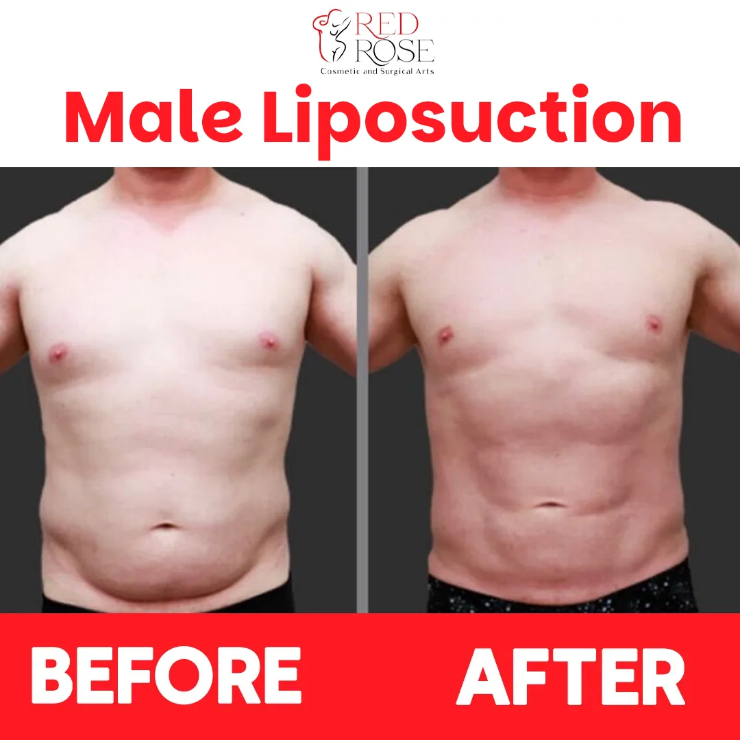 Lipo 360 before and after at Red Rose Surgical