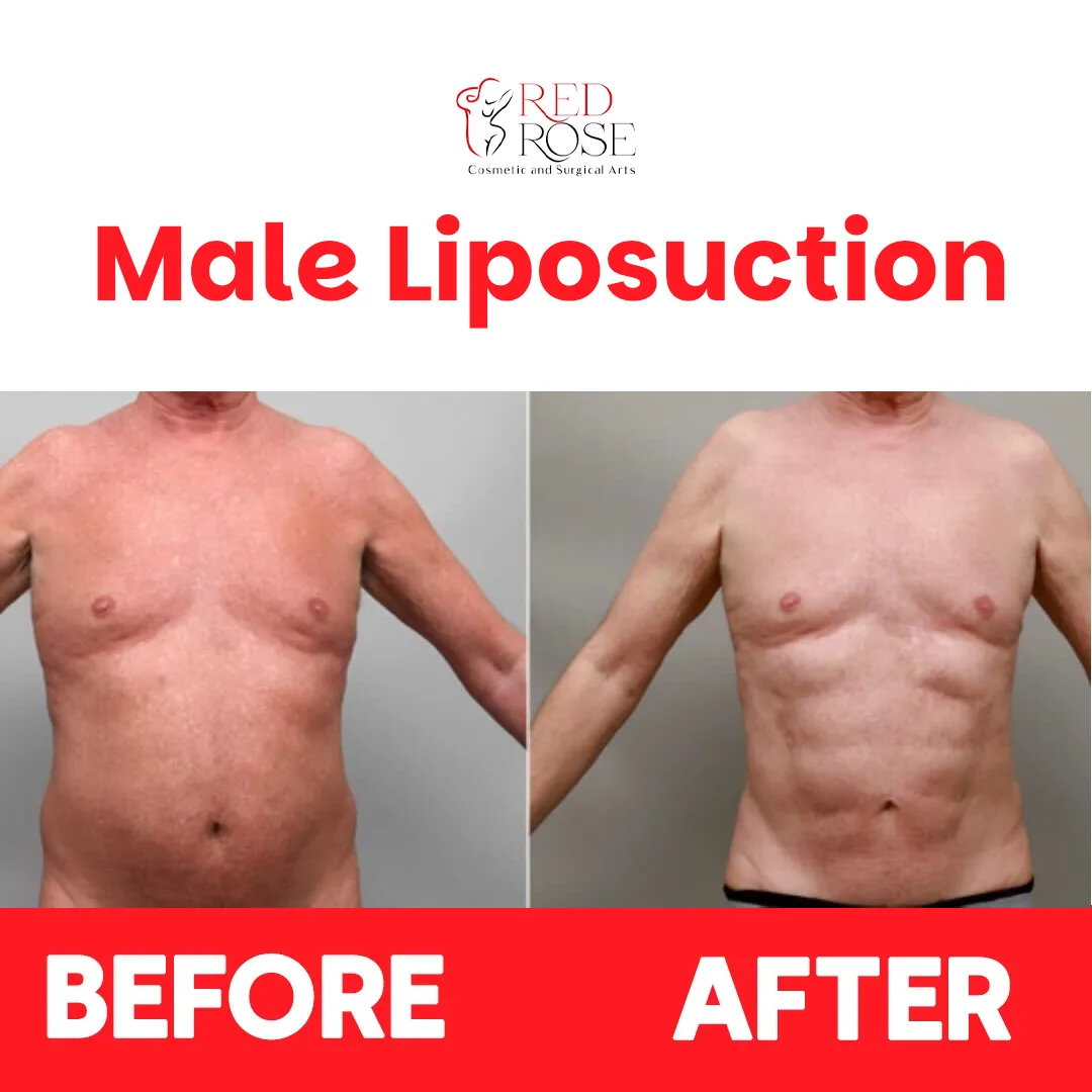 Before and after Liposuction at Red Rose Surgical