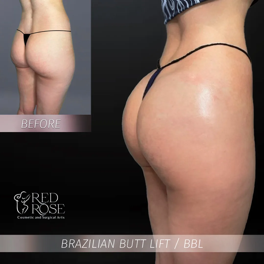 BBL before and after at Red Rose Surgical
