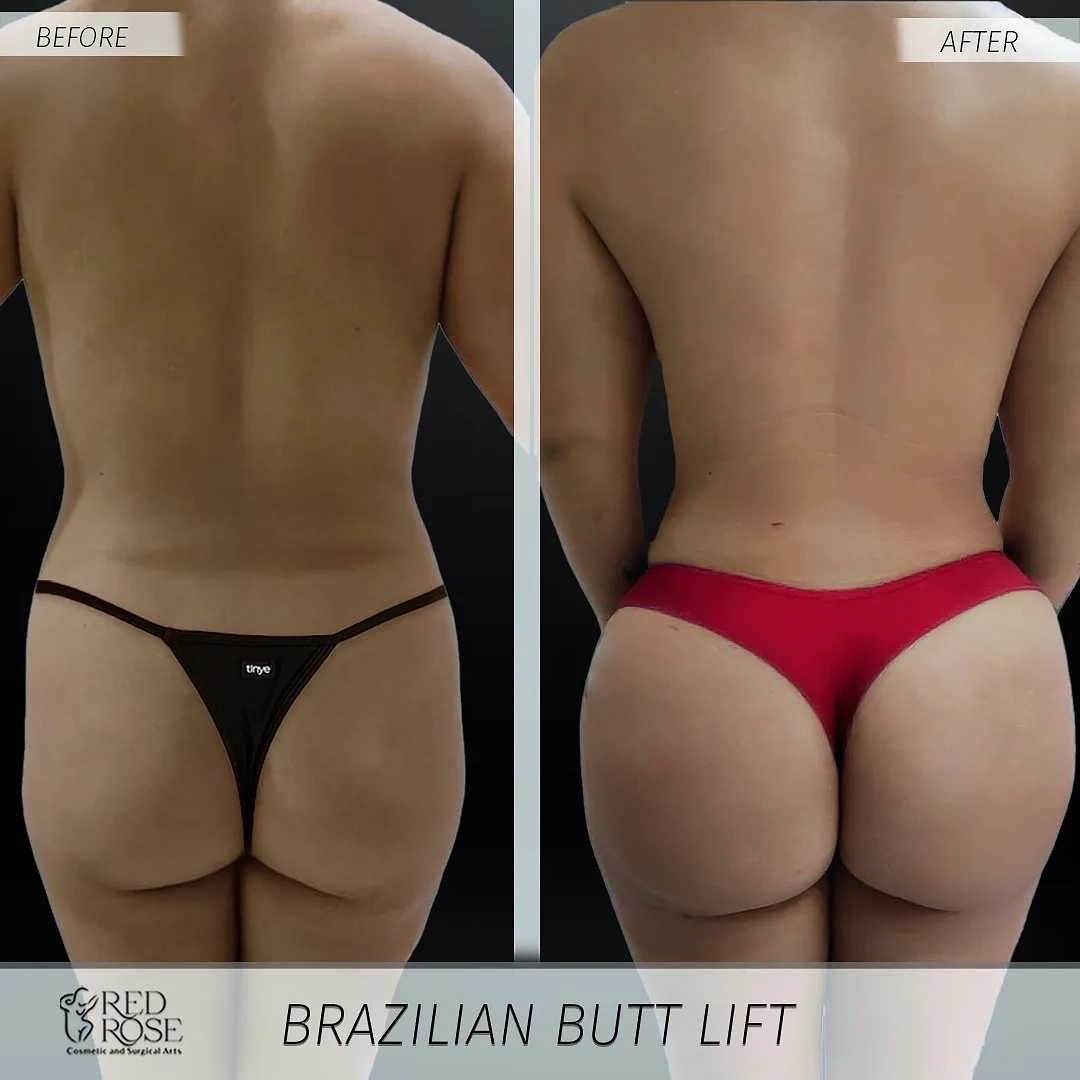 BBL before and after at Red Rose Surgical