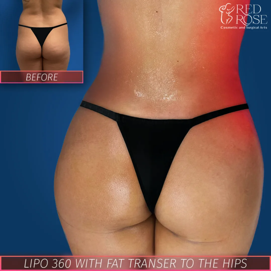 Before and after Brazilian Butt Lift at Red Rose Surgical