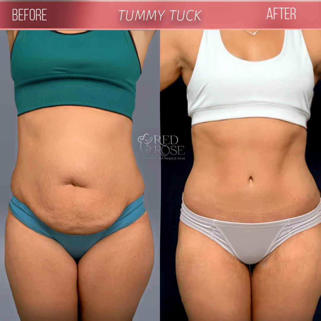 Tummy Tuck before and after at Red Rose Surgical