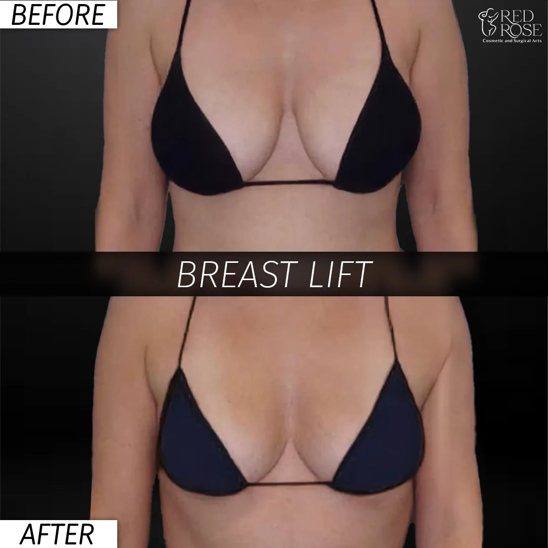 Before and after Breast Lift at Red Rose Surgical