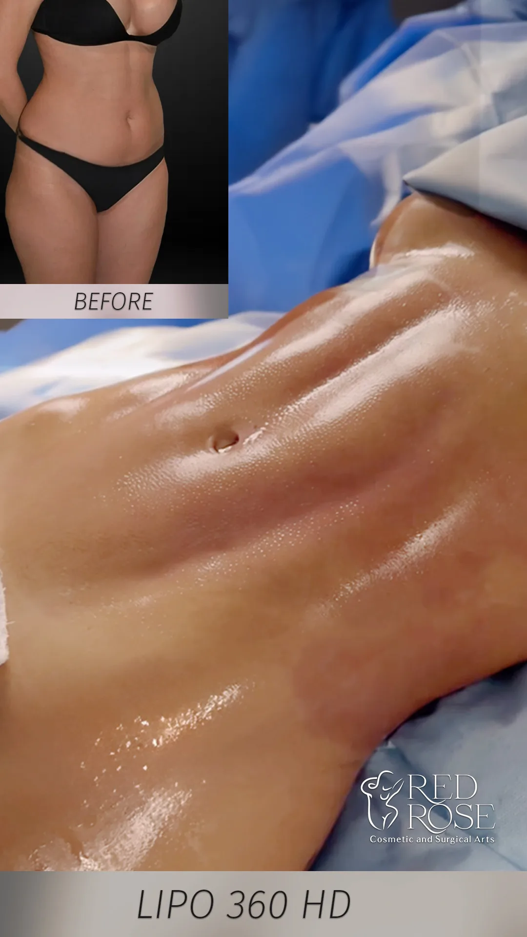 Before and after Liposuction at Red Rose Surgical