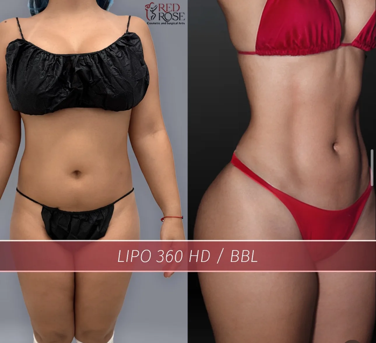 Before and after Liposuction at Red Rose Surgical