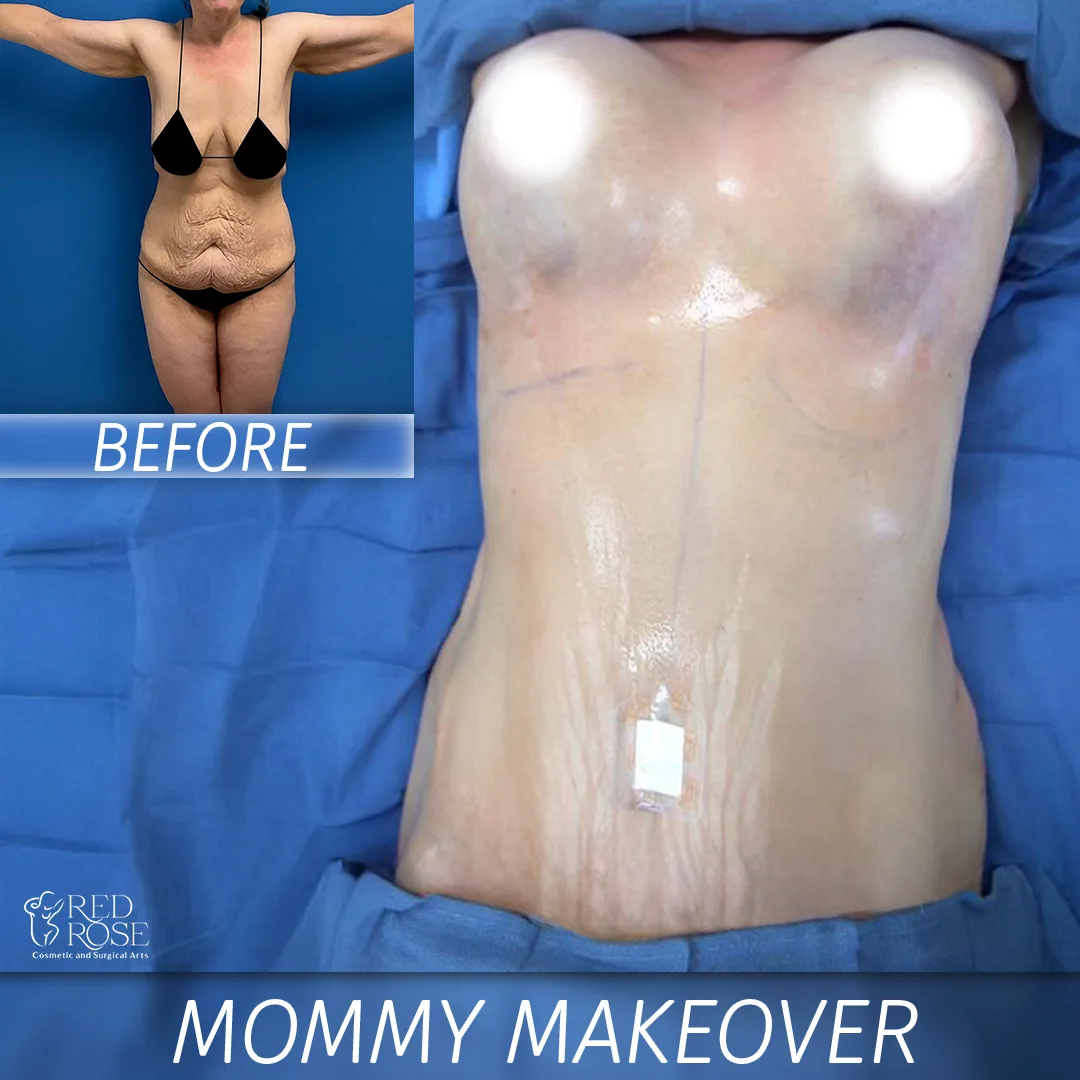 Before and after Mommy Makeover at Red Rose Surgical