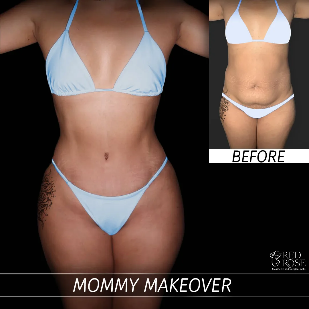 Before and after Mommy Makeover at Red Rose Surgical