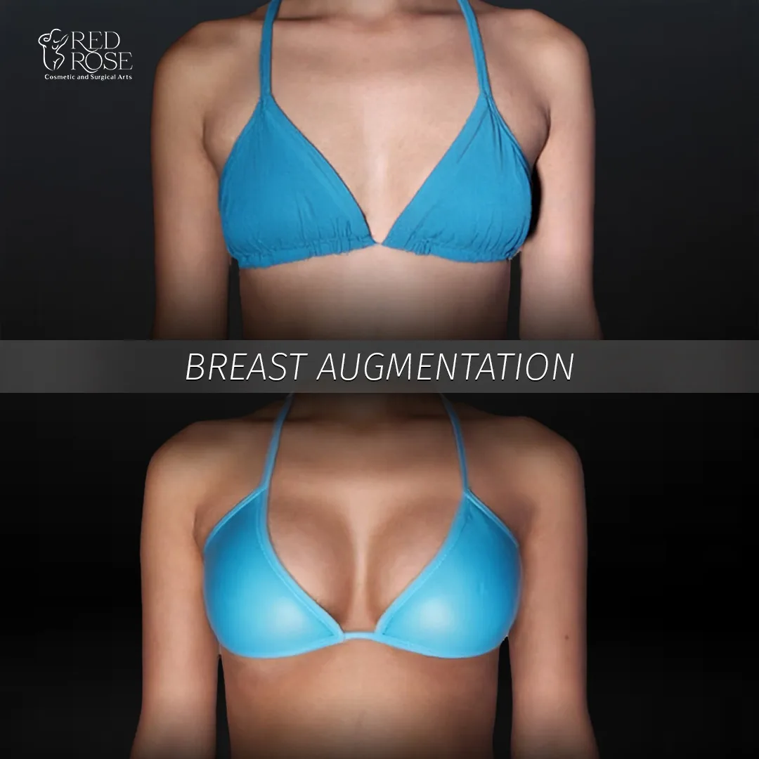 Before and after Breast Augmentation at Red Rose Surgical