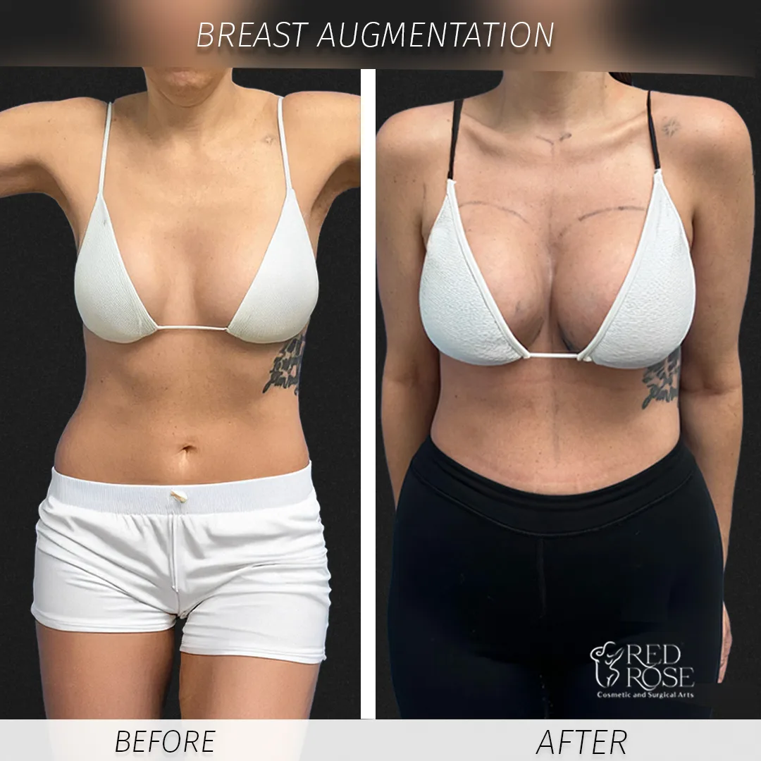 Before and after Breast Augmentation at Red Rose Surgical