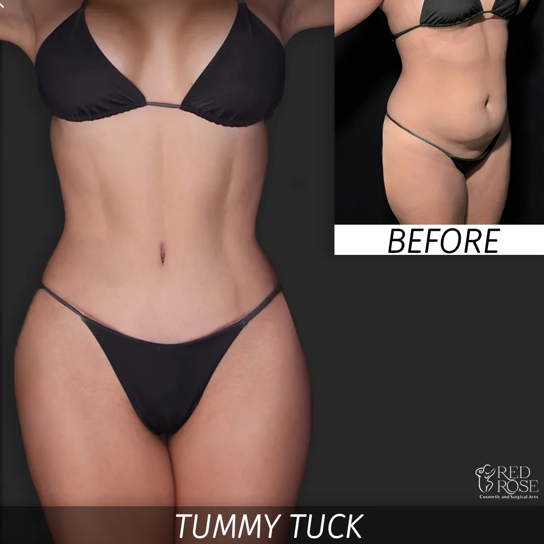 Before and after Tummy Tuck at Red Rose Surgical