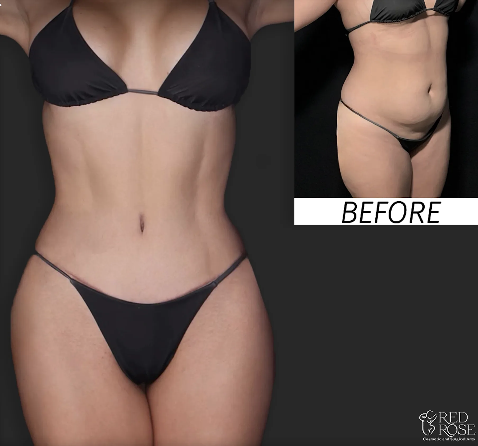 Mommy Makeover before and after at Red Rose Surgical